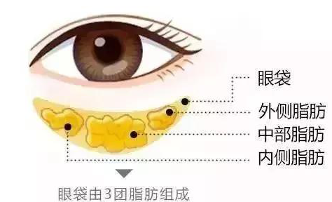 超声波去眼袋