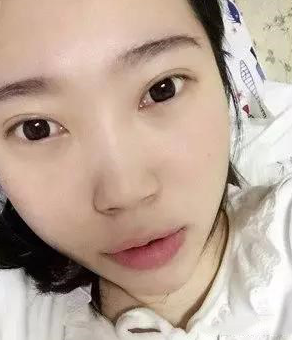超声波去眼袋