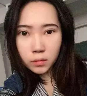 超声波去眼袋