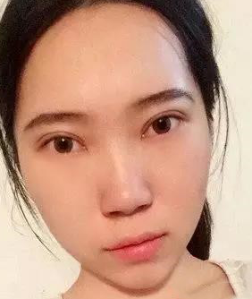 超声波去眼袋