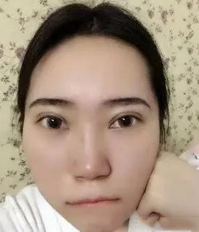 超声波去眼袋