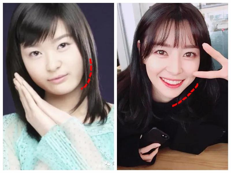 超声波瘦脸