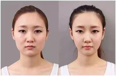 超声波瘦脸