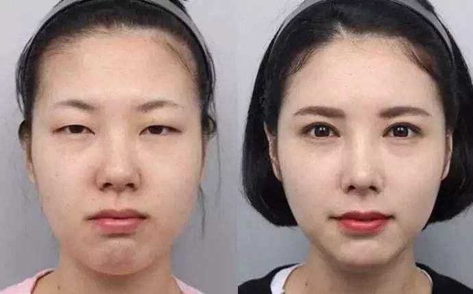 双眼皮手术