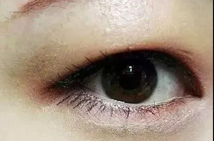 双眼皮手术