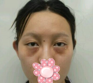 超声波去眼袋