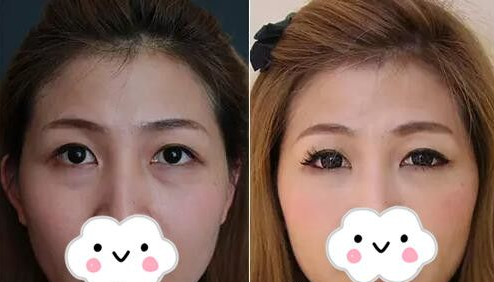 超声波去眼袋