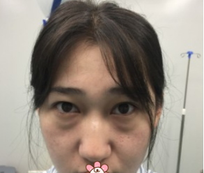 超声波去眼袋