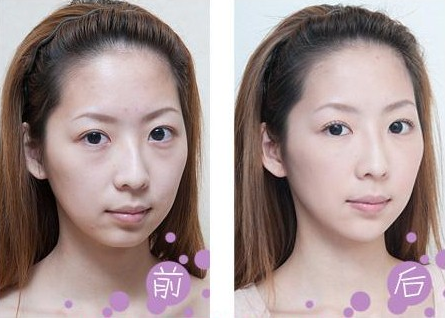 超声波去眼袋