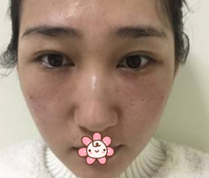 超声波去眼袋