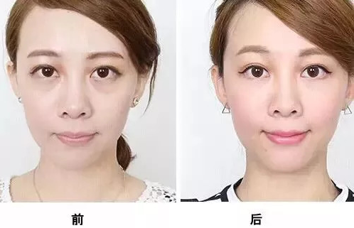 超声波去眼袋