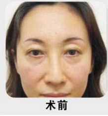 超声波去眼袋