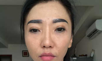 超声波去眼袋