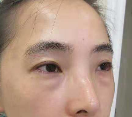 超声波去眼袋