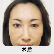 超声波去眼袋