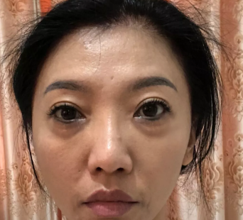 超声波去眼袋