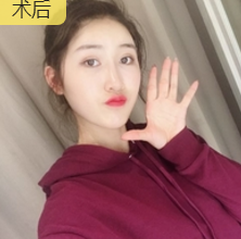 超声波去眼袋