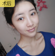 超声波去眼袋
