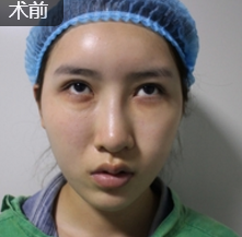 超声波去眼袋