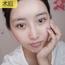超声波去眼袋