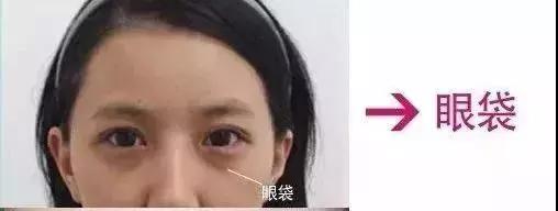 超声波去眼袋