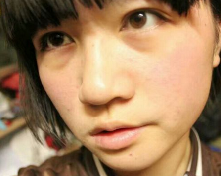 超声波去眼袋