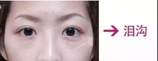 超声波去眼袋
