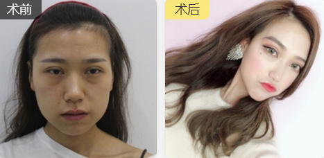 超声波去眼袋