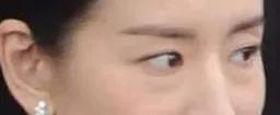 超声波去眼袋