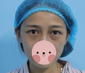 超声波去眼袋