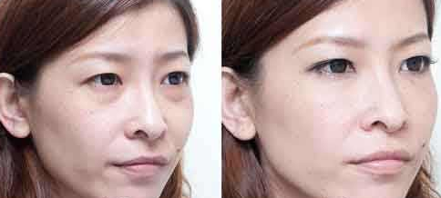 超声波去眼袋
