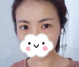 超声波去眼袋
