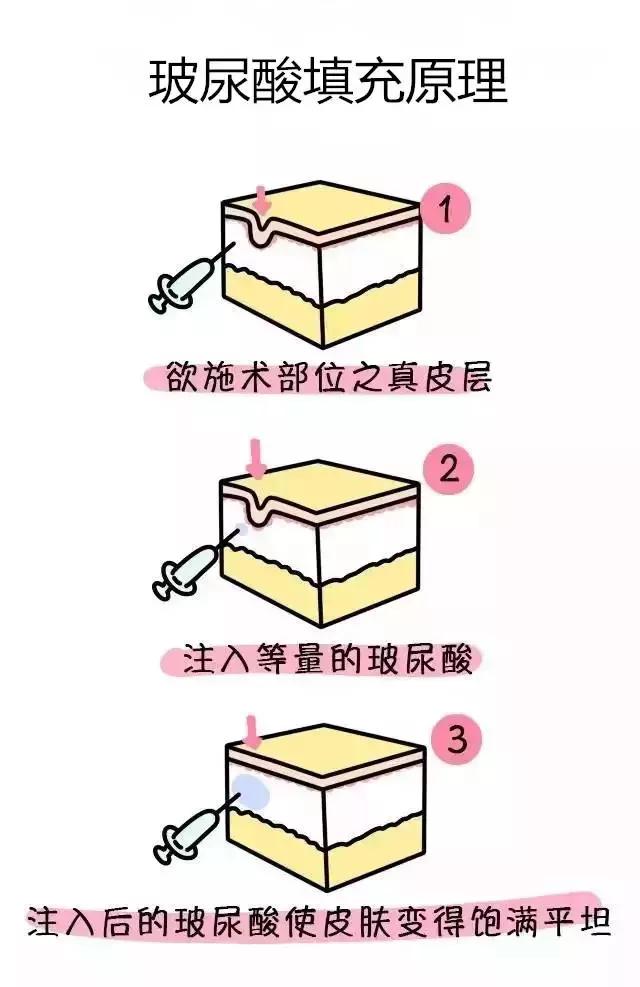 超声波去眼袋