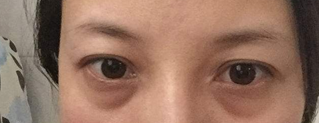 超声波去眼袋