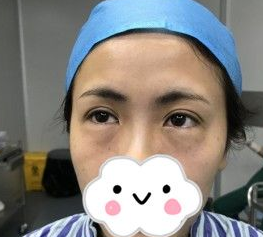 超声波去眼袋