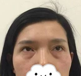 超声波去眼袋