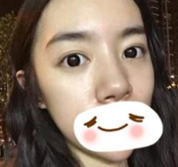超声波去眼袋