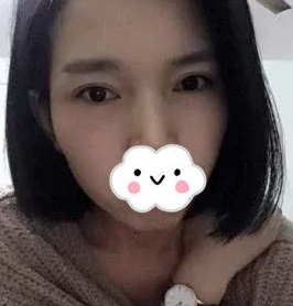 超声波去眼袋