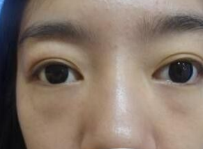 超声波去眼袋