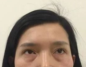 超声波去眼袋