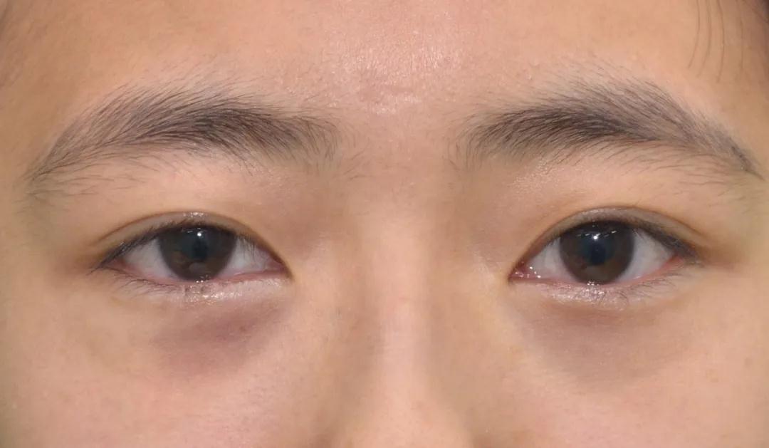 去眼袋手术