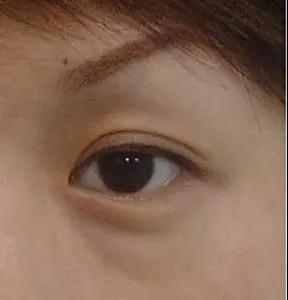 去眼袋手术