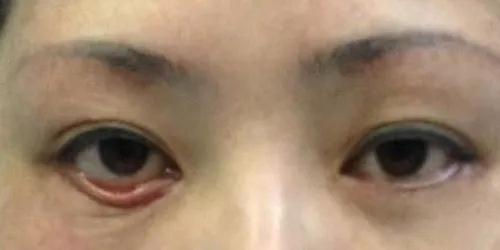 去眼袋手术