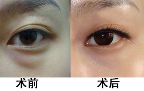 去眼袋手术