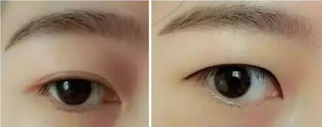 双眼皮手术