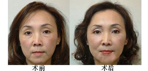 去眼袋手术