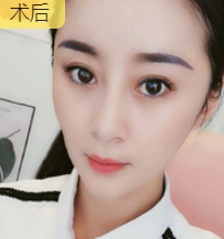 去眼袋手术
