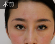 去眼袋手术