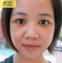 去眼袋手术