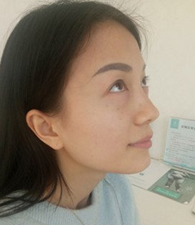 去眼袋手术
